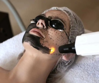 Peel Carbon Laser - Traitement de visage et corps