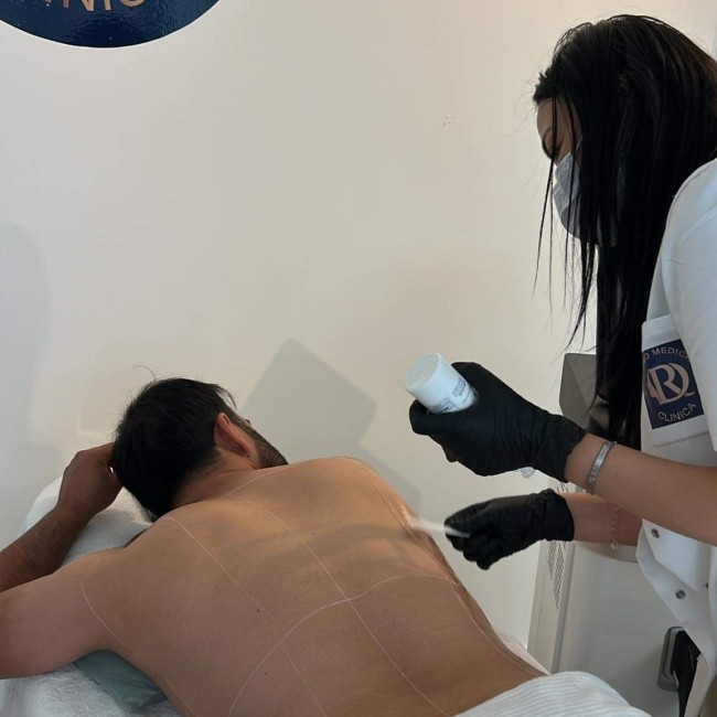 Permanent laser hair removal of the back